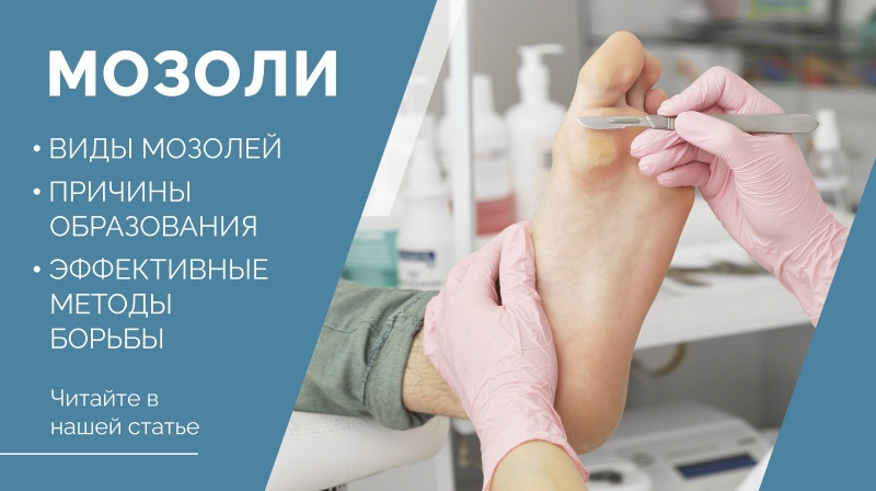 Причины образования мозолей и эффективные методы борьбы с ними.
