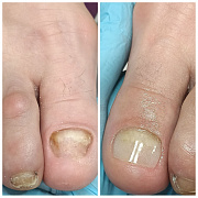 Методики и материалы для   протезирования проблемных,   ногтей.   Выбор оптимальной   технологии протезирования