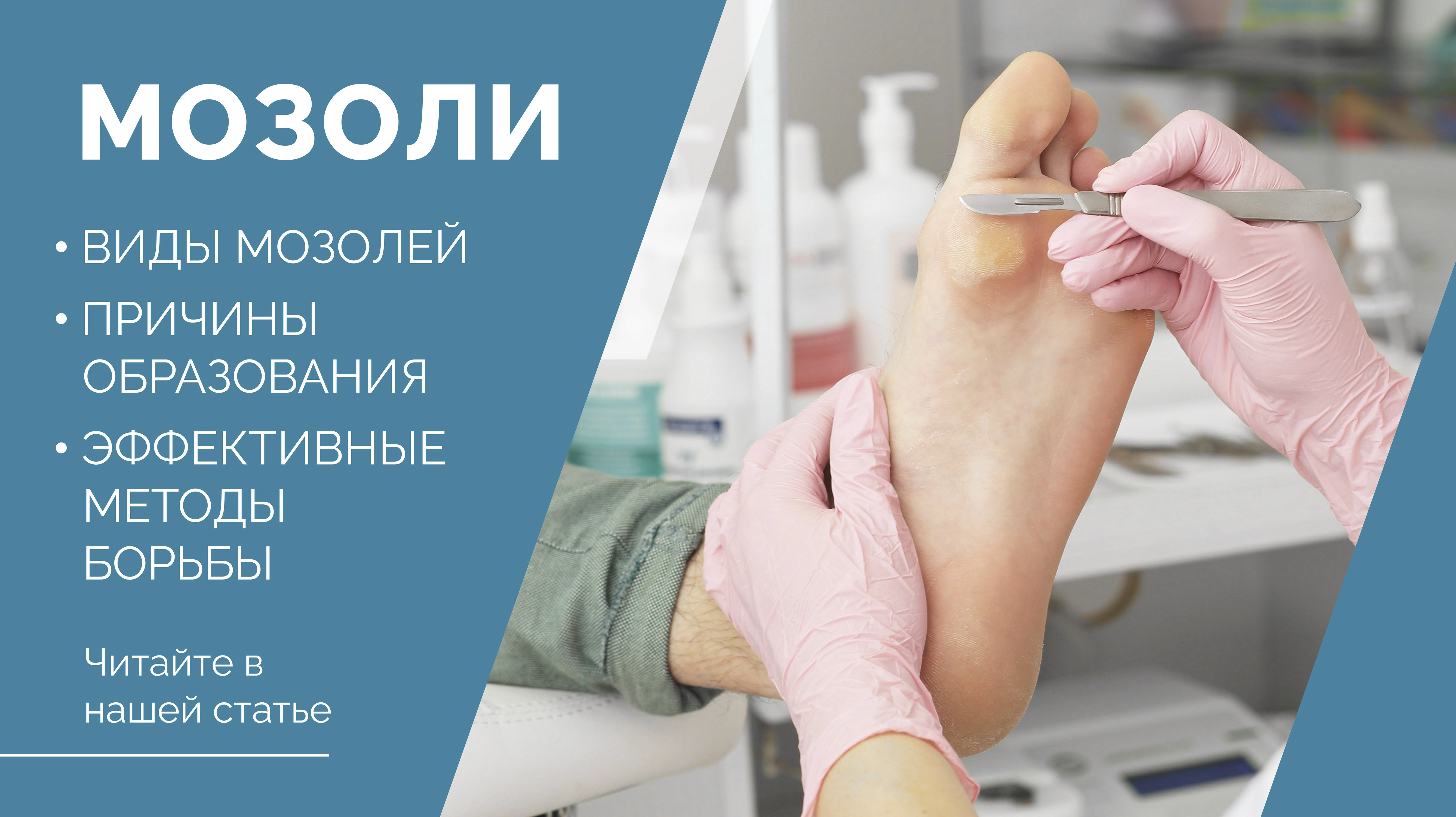 Причины образования мозолей и эффективные методы борьбы с ними.<